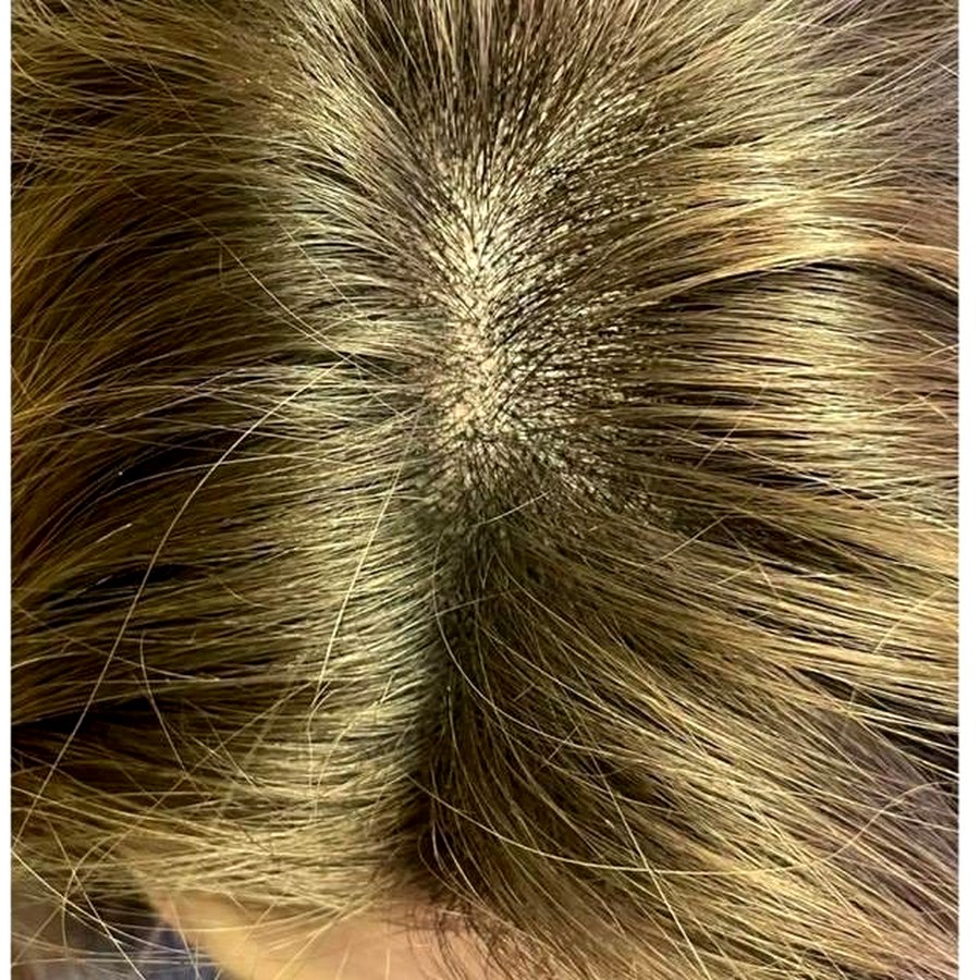 Hair thinning after treatment