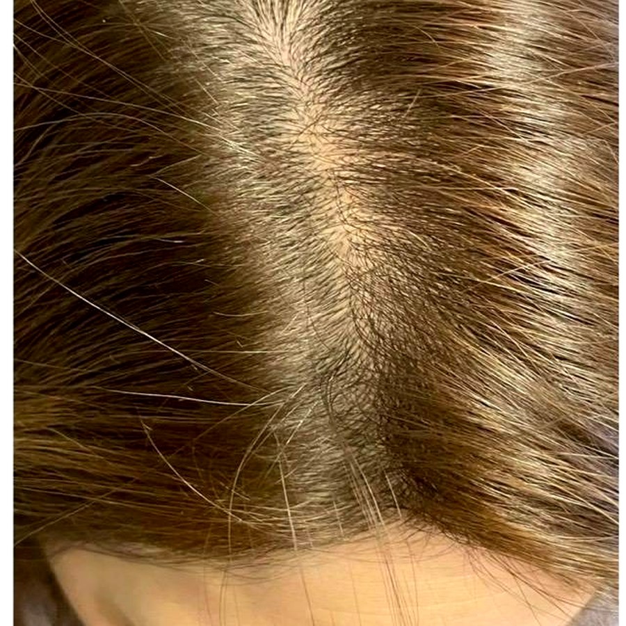 Hair thinning before treatment