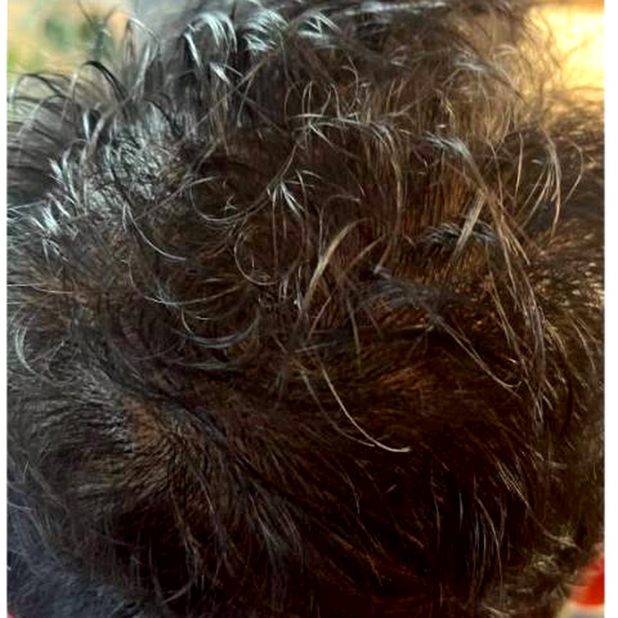 Hair thinning after treatment