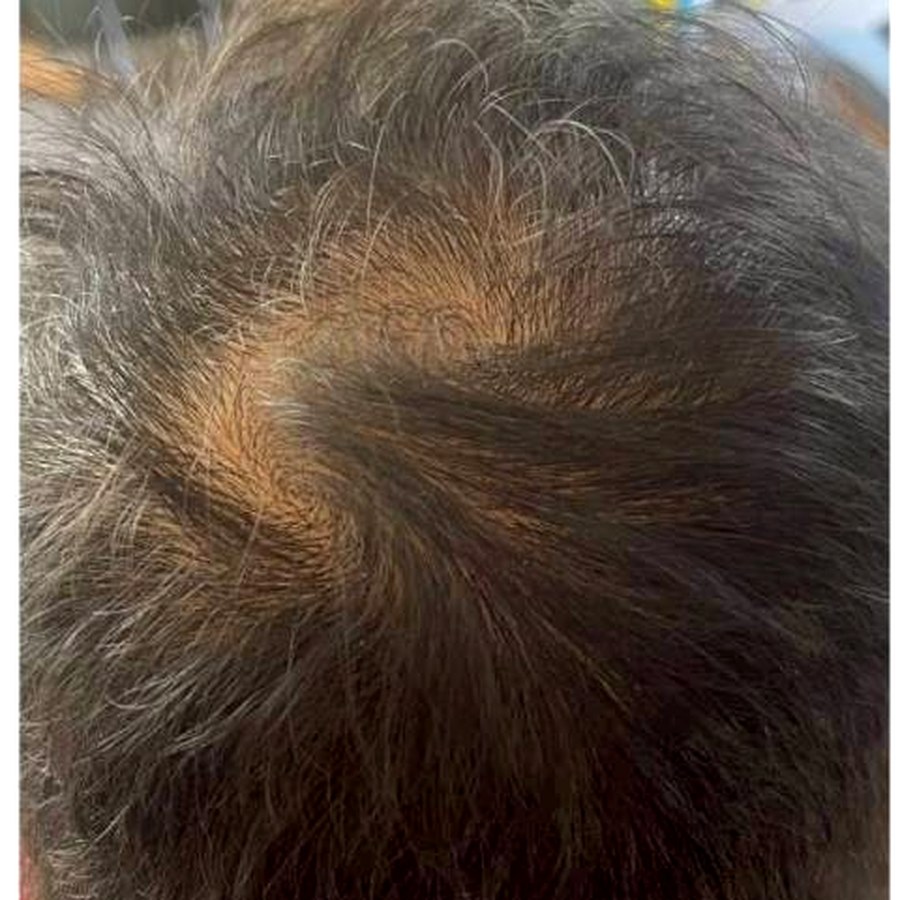 Hair thinning before treatment