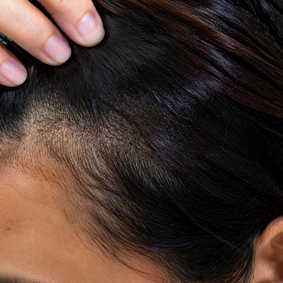 Scar cover after treatment