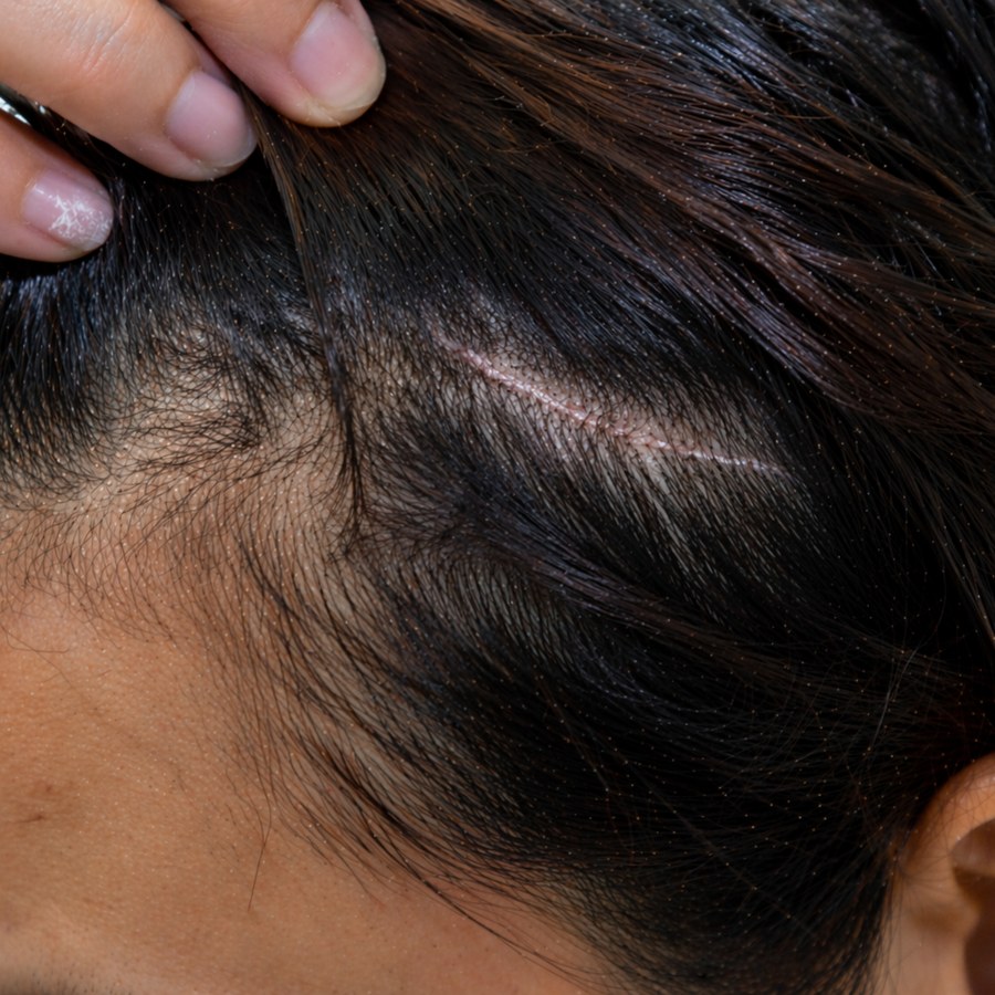 Scar cover before treatment